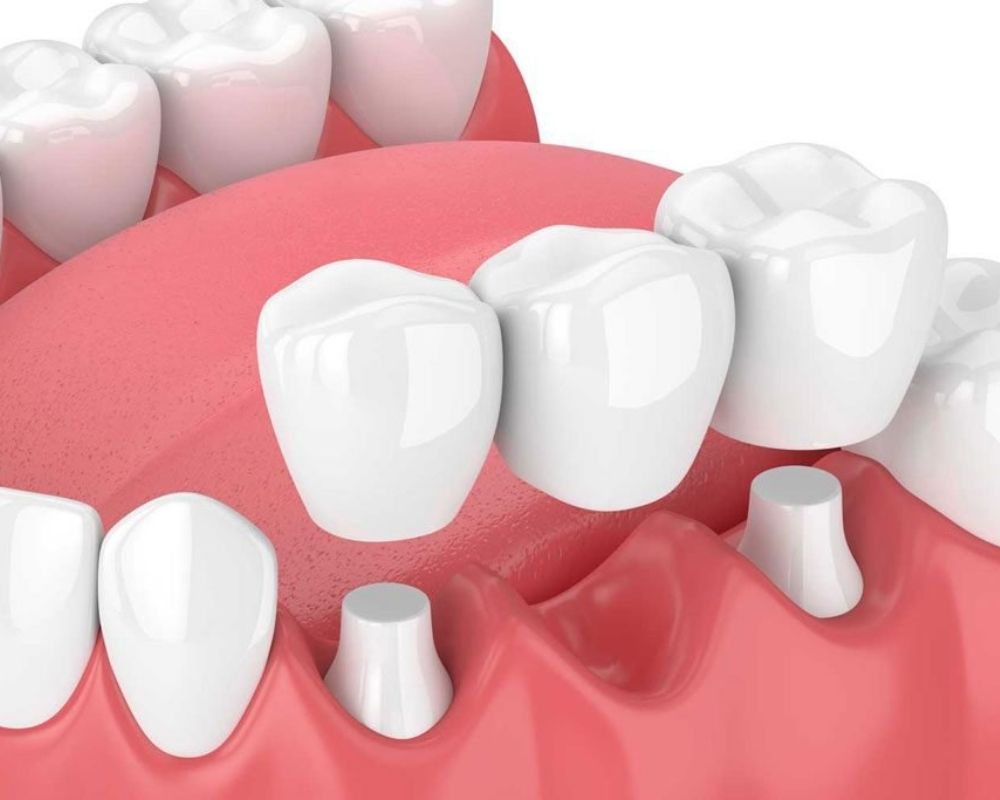 Bảng giá trồng răng implant
